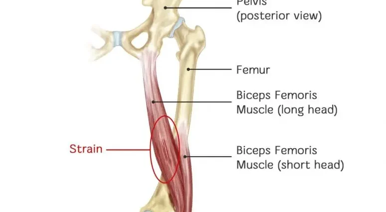 Femoral biceps