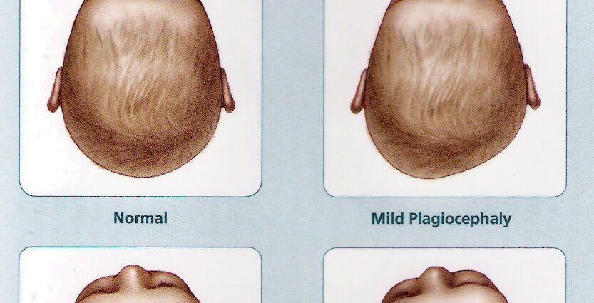 Flat heads in babies: what is plagiocephaly?