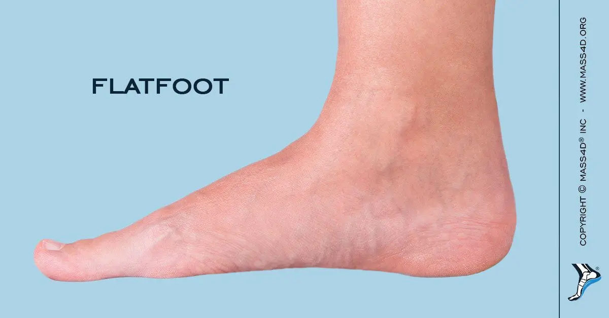 Flat soles are unhealthy