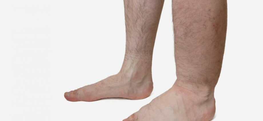 Fluid retention in the body: causes of edema. Video