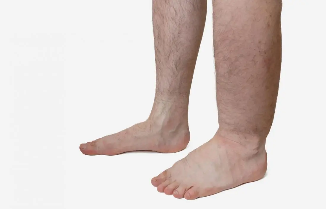 Fluid retention in the body: causes of edema. Video