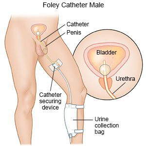 Foley catheter: what is it for?