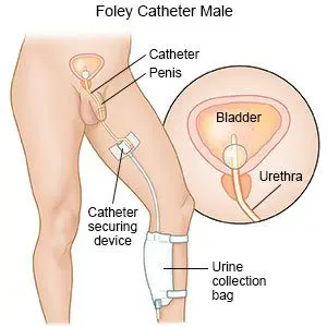 Foley catheter: what is it for?