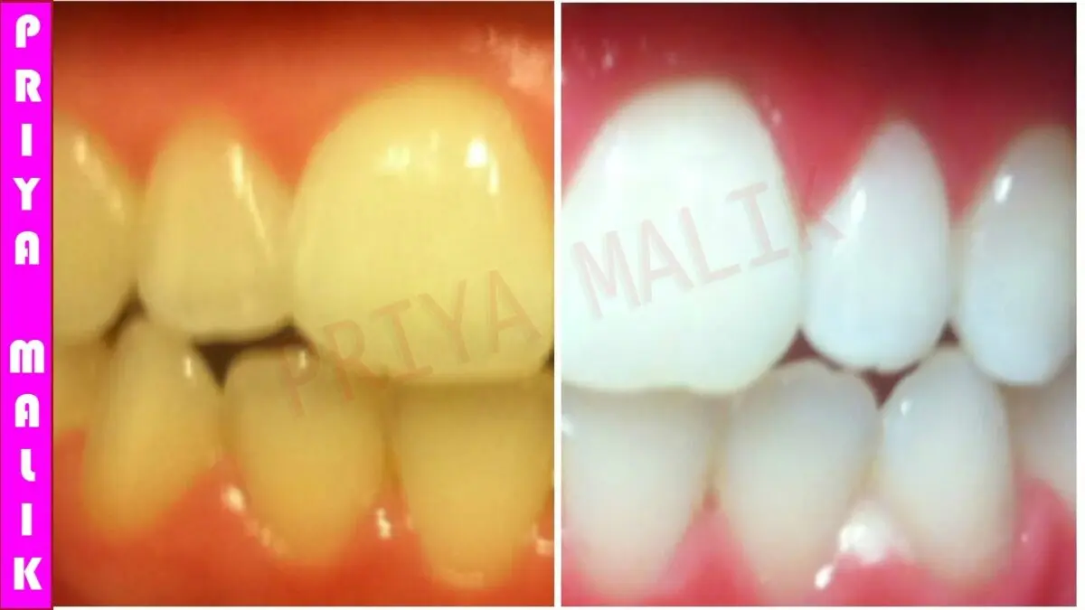 Folk remedies for teeth whitening. Video