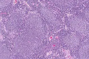 Follicular lymphoma