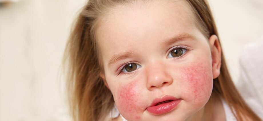 Food allergies in children