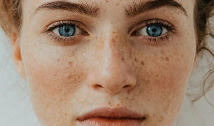 Freckles: how to get rid of them forever? Video