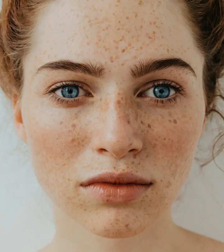 Freckles: how to get rid of them forever? Video