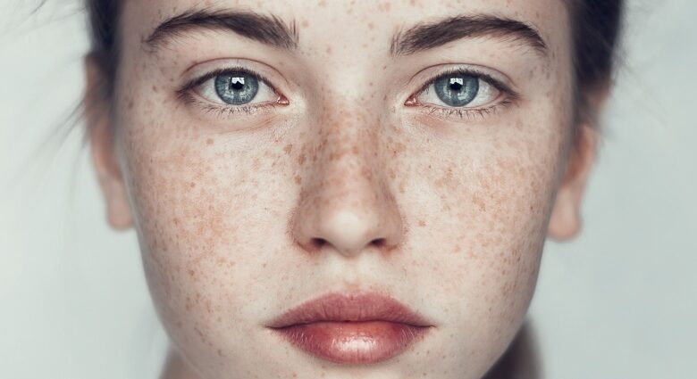 Freckles on the face &#8211; where do they come from and whether it is necessary to fight them. How to get rid of freckles at home