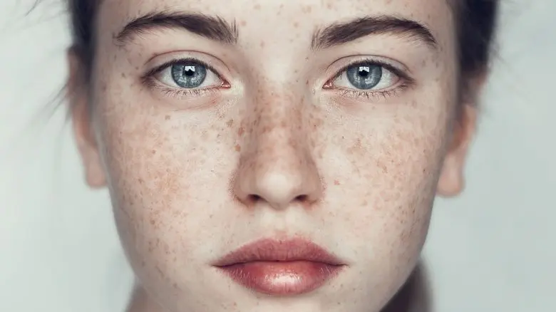 Freckles on the face &#8211; where do they come from and whether it is necessary to fight them. How to get rid of freckles at home