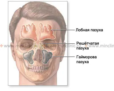 Frontitis, Frontal sinusitis symptoms, Treatment of frontal sinusitis, Acute frontal sinusitis, Treatment of frontal sinusitis at home