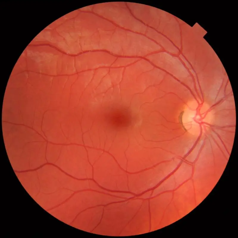 Fundus: when to do it, why, normal or not?