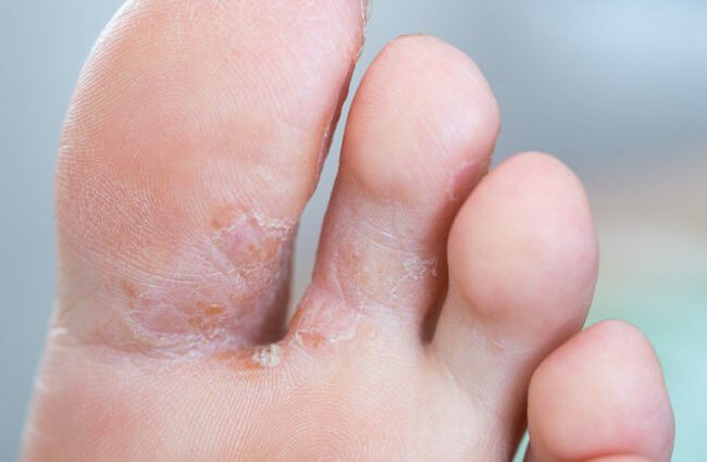 Fungus on the feet: symptoms