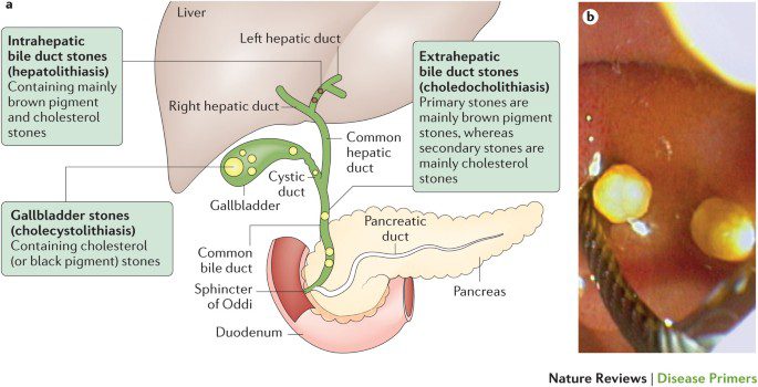 Камен у жучи (холелитијаза) – комплементарни приступи