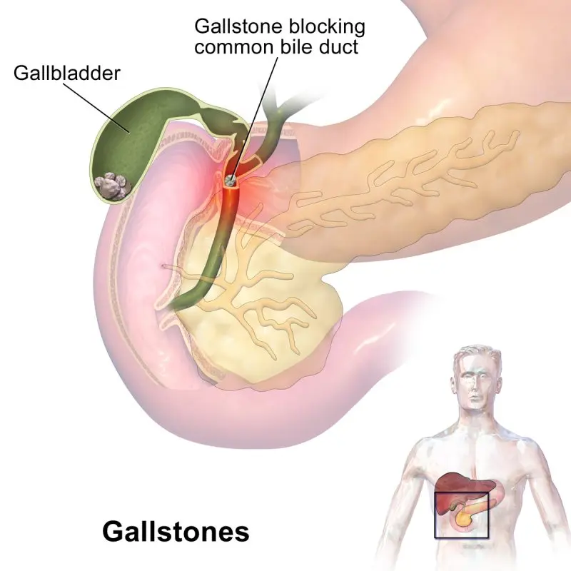 Gallstones (cholelithiasis)