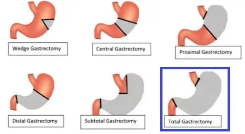 Gastrectomy