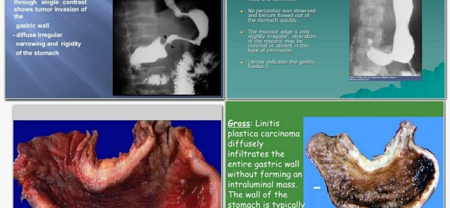 Gastric linitis