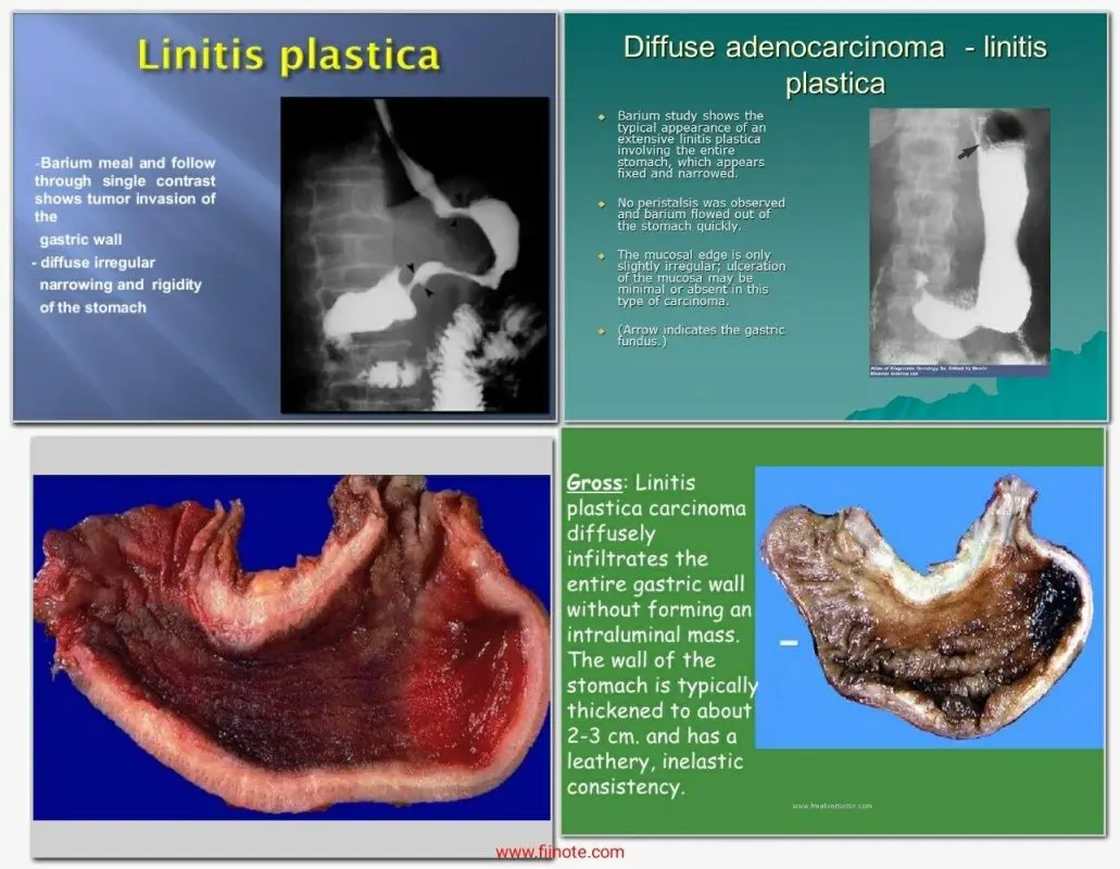 Gastric linitis