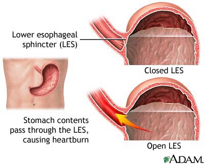 Gastroesophageal Reflux Disease (Heartburn) &#8211; Our Doctor&#8217;s Opinion