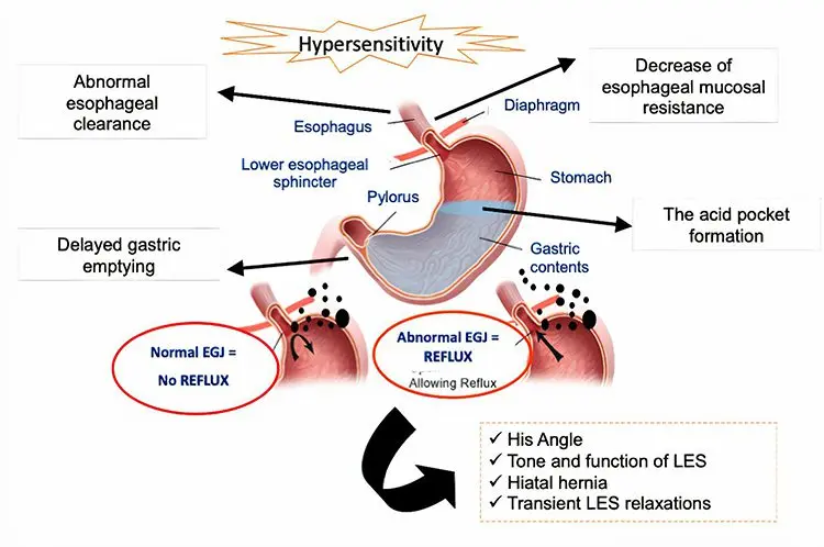Gastroesophageal Reflux Disease (Heartburn) &#8211; Sites of Interest