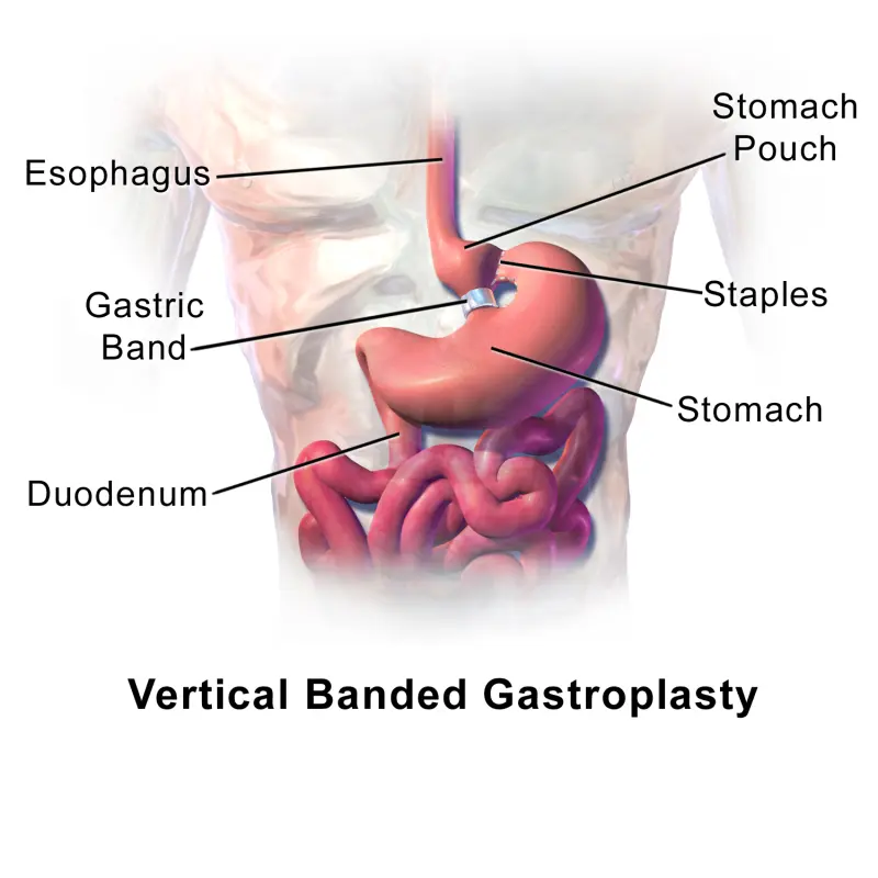 Gastroplasty