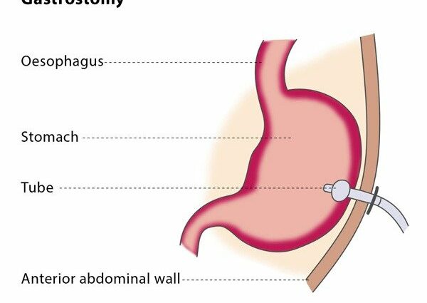 Gastrostomy