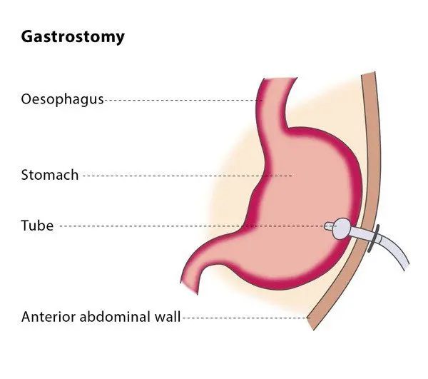 Gastrostomy