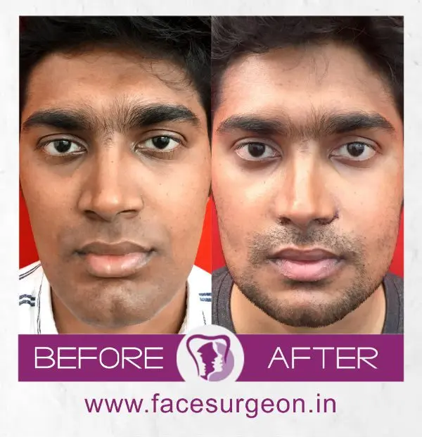 Genioplasty: all you need to know about mentoplasty