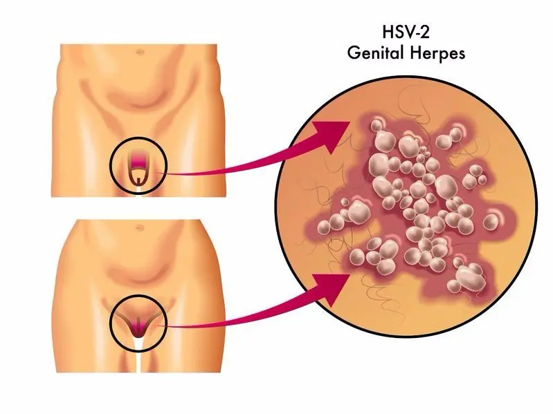 Genital herpes &#8211; Sites of interest