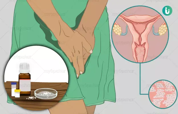 Genital yeast infection: what are the aggravating factors?