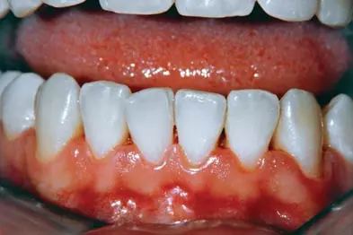 Gingivitis &#8211; Our doctor&#8217;s opinion