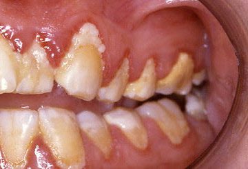 歯肉炎–参考文献と関心のあるサイト