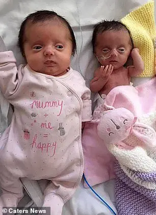 Glass babies: twins were born with broken bones