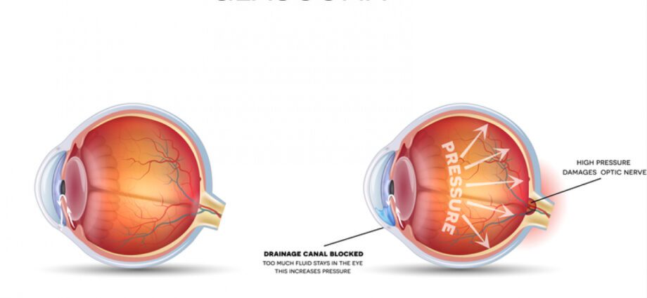 Glaucoma - دلچسپي جون سائيٽون