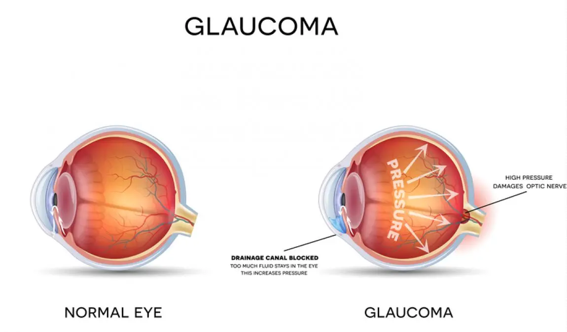 Glaucoma &#8211; Sites of interest