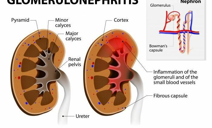 Glomerulonephritis: zvese nezve chirwere cheitsvo