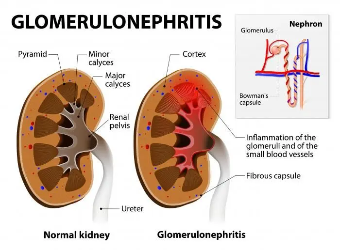 Glomerulonephritis: all about this kidney disease