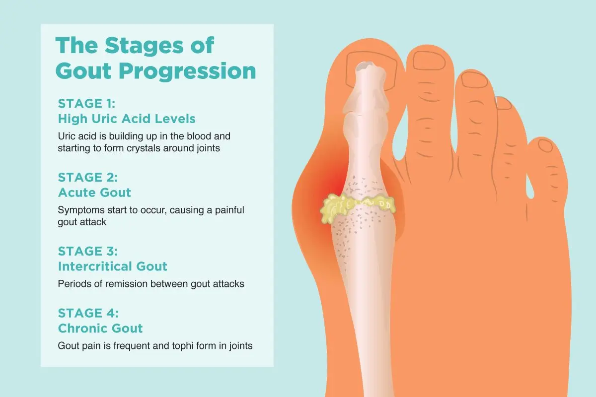 Gout: recognizing a gout attack