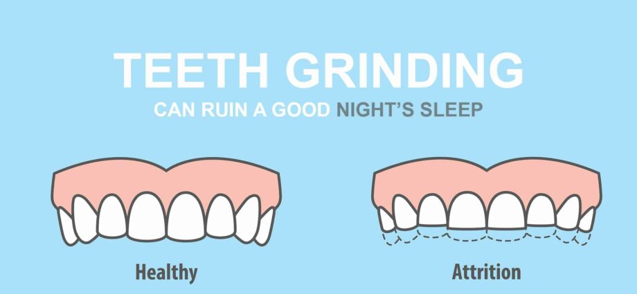 Grinding teeth: the causes of bruxism