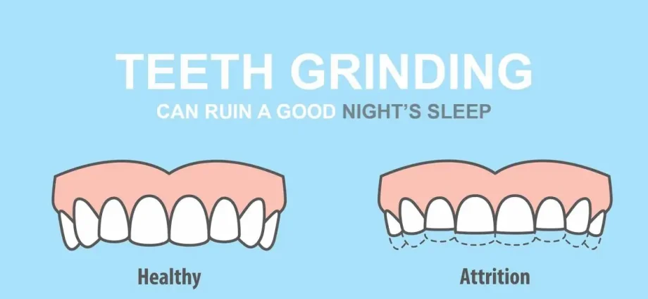 Grinding teeth: the causes of bruxism