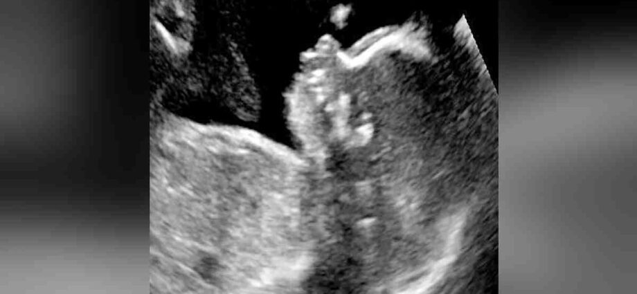 Growing in the womb and visible on ultrasound: 10 facts about children&#8217;s hair