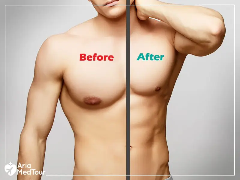 Gynecomastia: what is it?