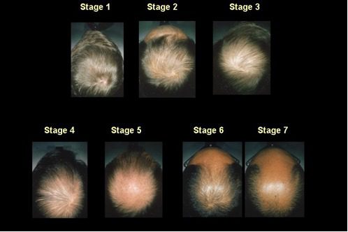 Hair loss in men: inventory