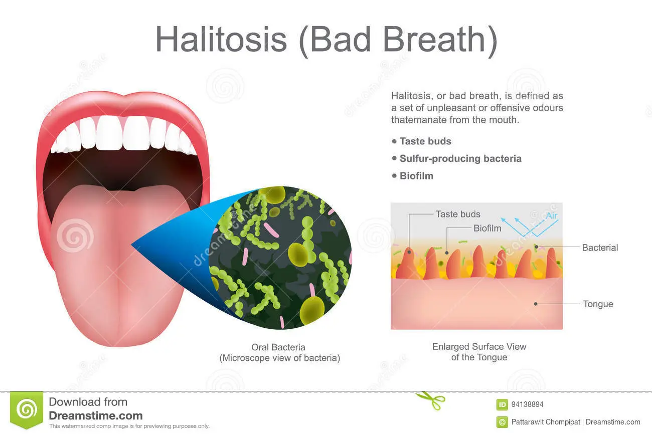 Halitosis (Bad breath) &#8211; Complementary approaches