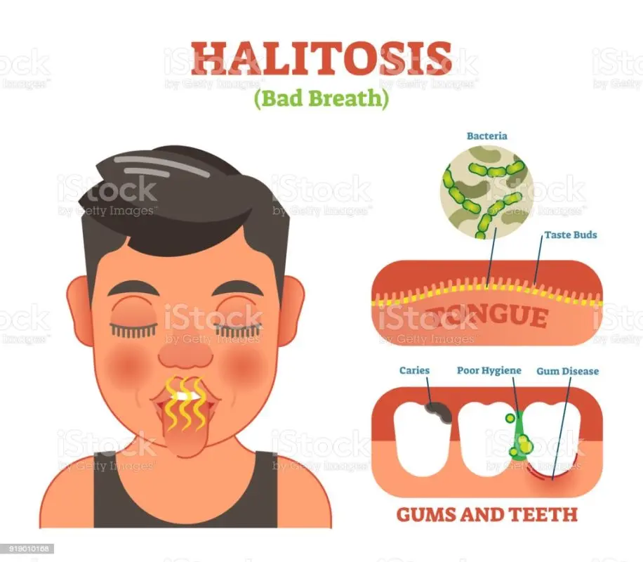 Halitosis (Bad breath) &#8211; Places of interest