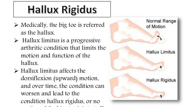 ہالکس rigidus