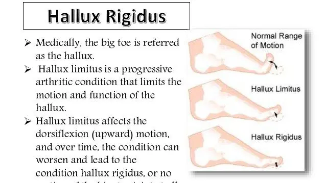 Hallux rigidus