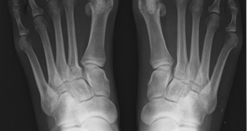Hallux valgus &#8211; Our doctor&#8217;s opinion