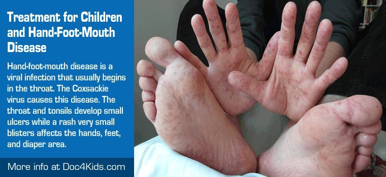 Hand-foot-mouth syndrome: symptoms and treatments for this disease