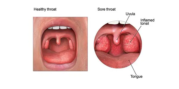 He has a sore throat, what if it was sore throat?